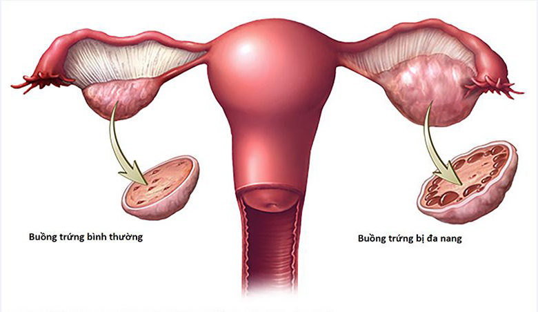 Hội chứng buồng trứng đa nang (PCOS)